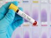 Here are important STD screening tests you must know about