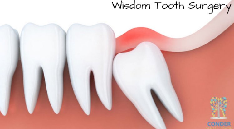 Tips for Fast Recovery after Wisdom Tooth Surgery