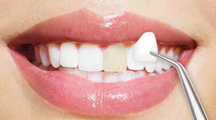 The Pros and Cons of Porcelain Veneers