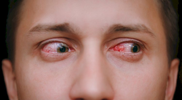 Relief from Red Eyes