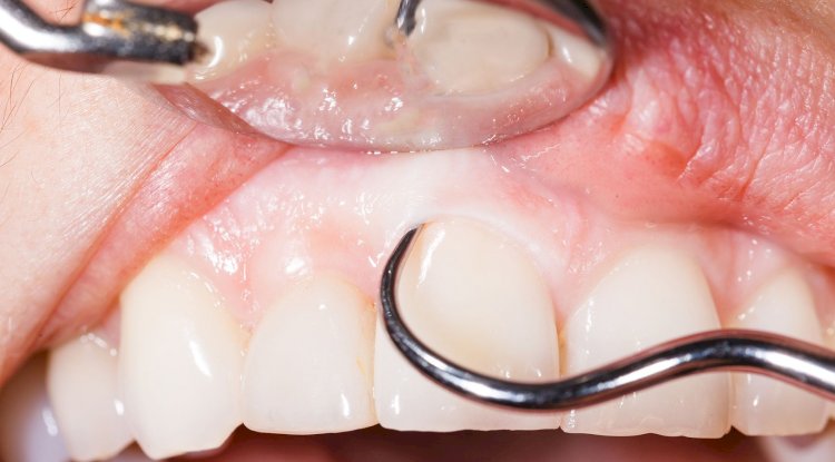 Oral Cancer Screenings And Biopsies