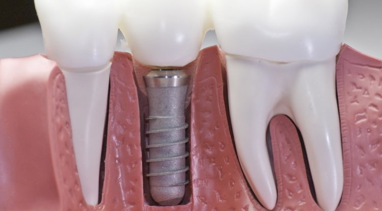 Things To Consider For Dental Implants