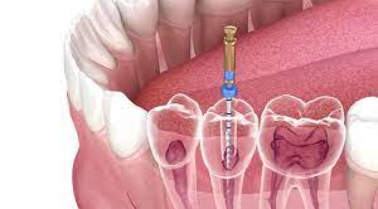 What to Expect After Having a Root Canal Treatment