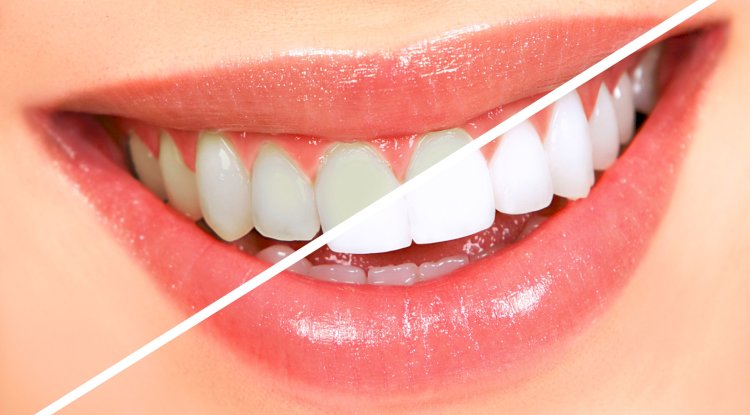Teeth Whitening in Melbourne: How to Achieve a Brighter Smile Safely