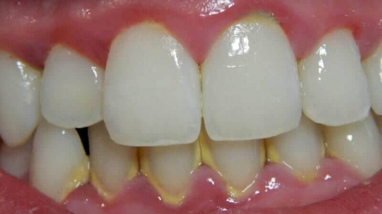 Plaque on the teeth