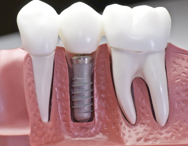 Things To Consider For Dental Implants