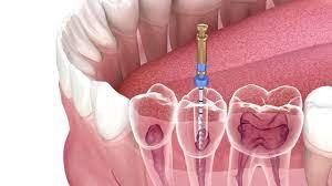 What to Expect After Having a Root Canal Treatment