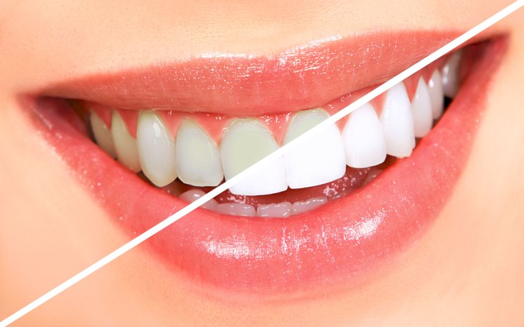 Teeth Whitening in Melbourne: How to Achieve a Brighter Smile Safely